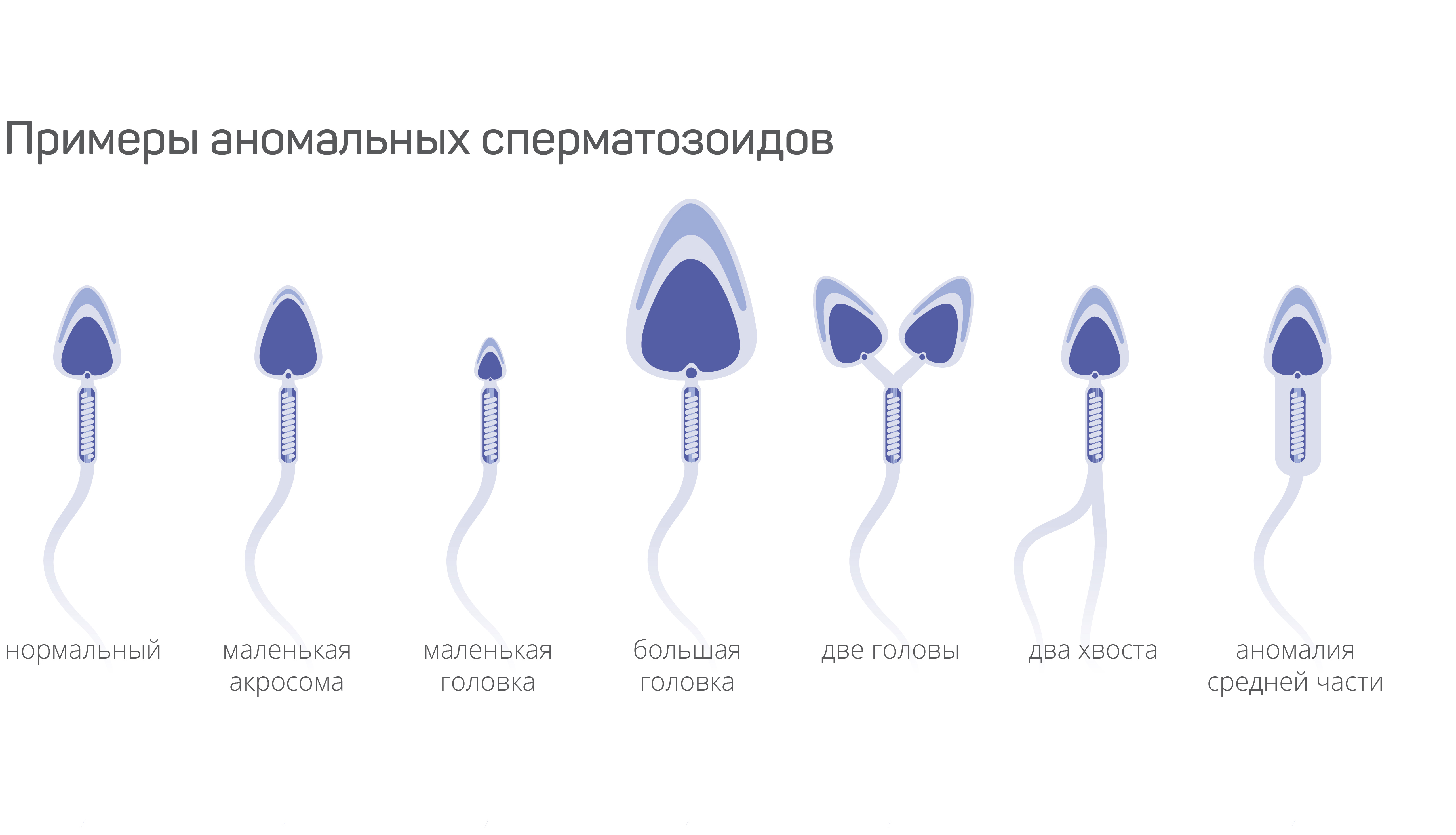 Тератоспермия (высокое содержание сперматозоидов с аномальным строением)