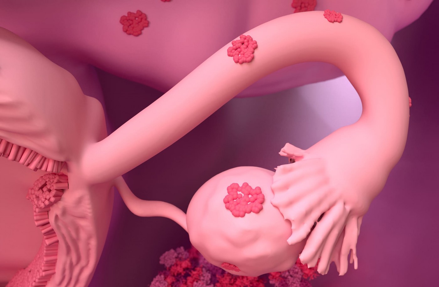 эндометриоз яичников