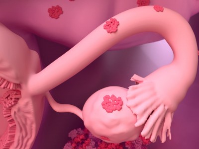 эндометриоз яичников